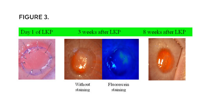 bio-compatible Cornea